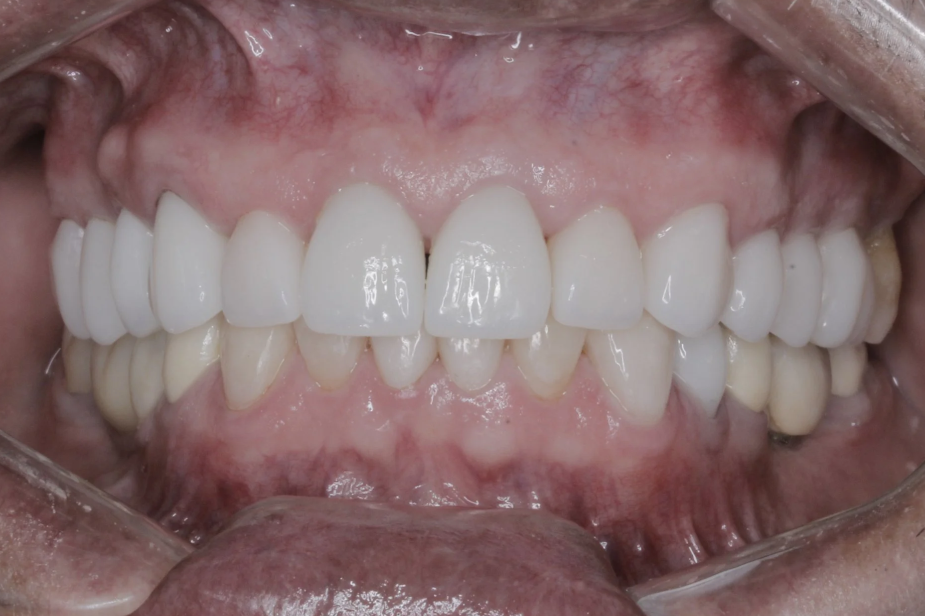 Fotografias finales
Cambio de coronas de metal porcelana por coronas sin metal.
+ Nuevo color 