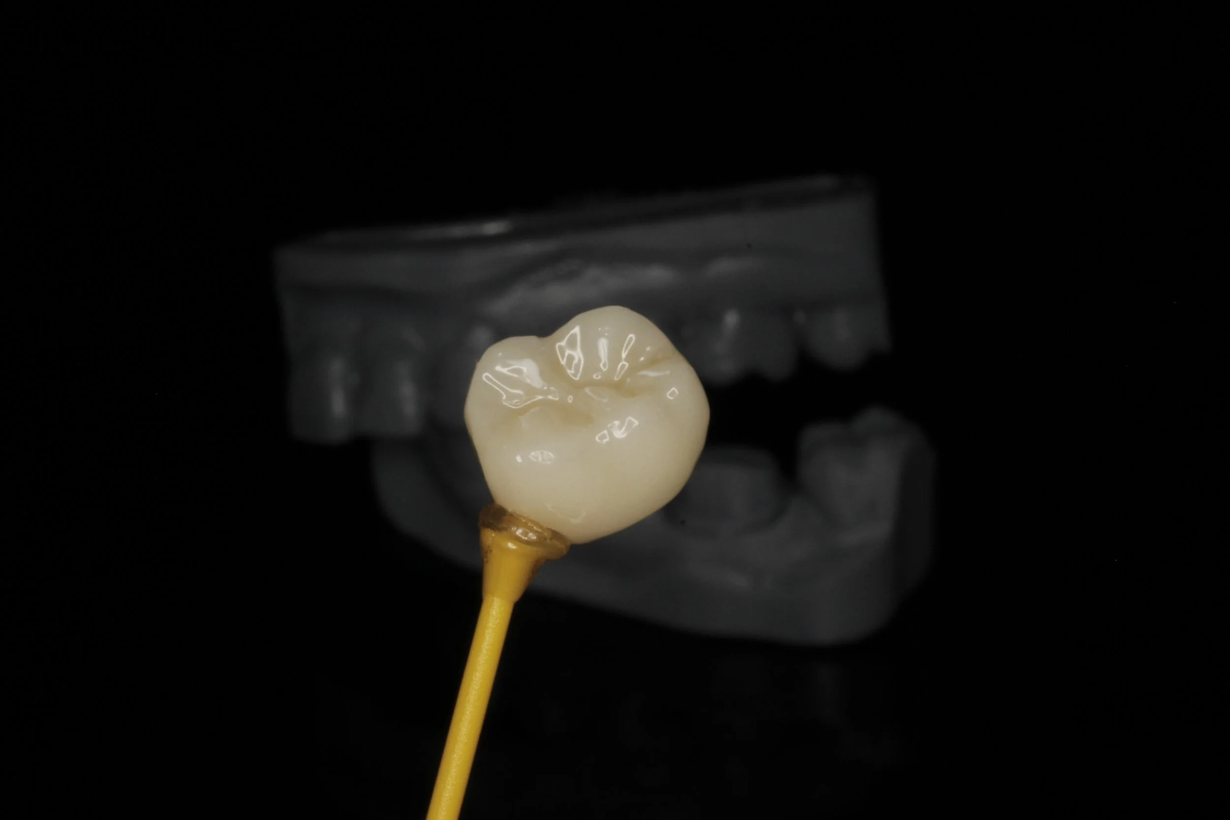 Corono de zirconia