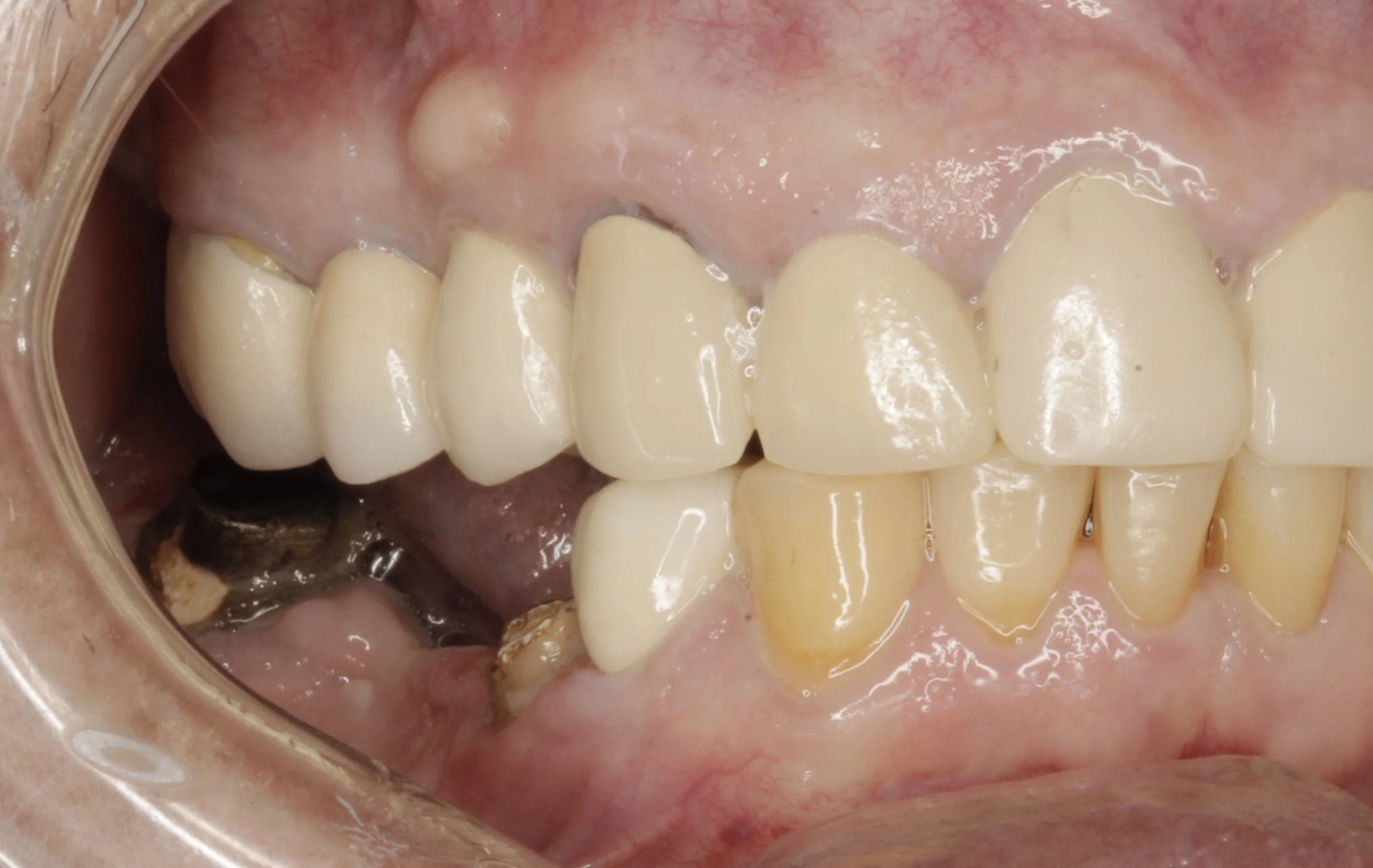 Antes
Fractura de puente fijo