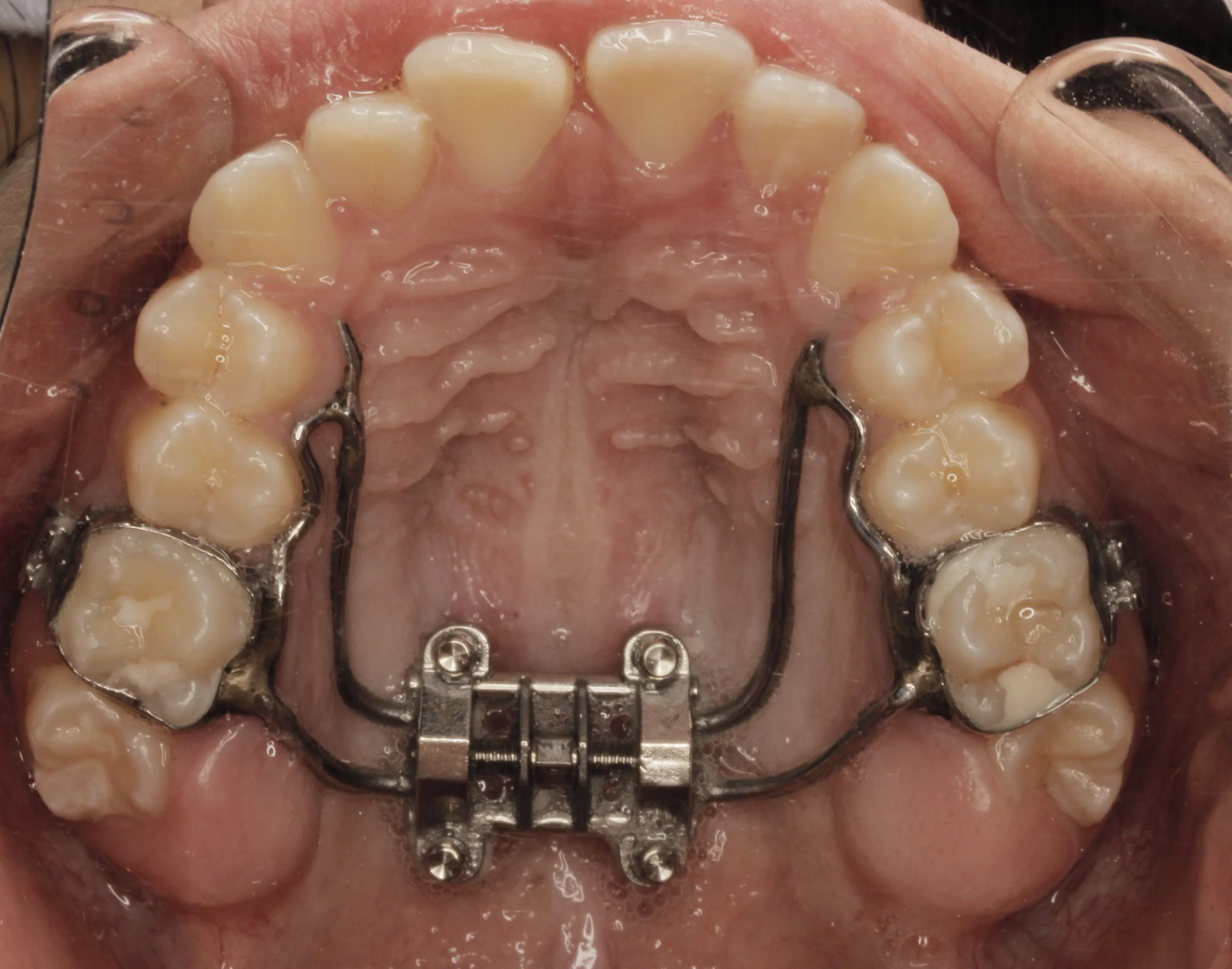 Expansor maxilar/ ortopedia maxilar