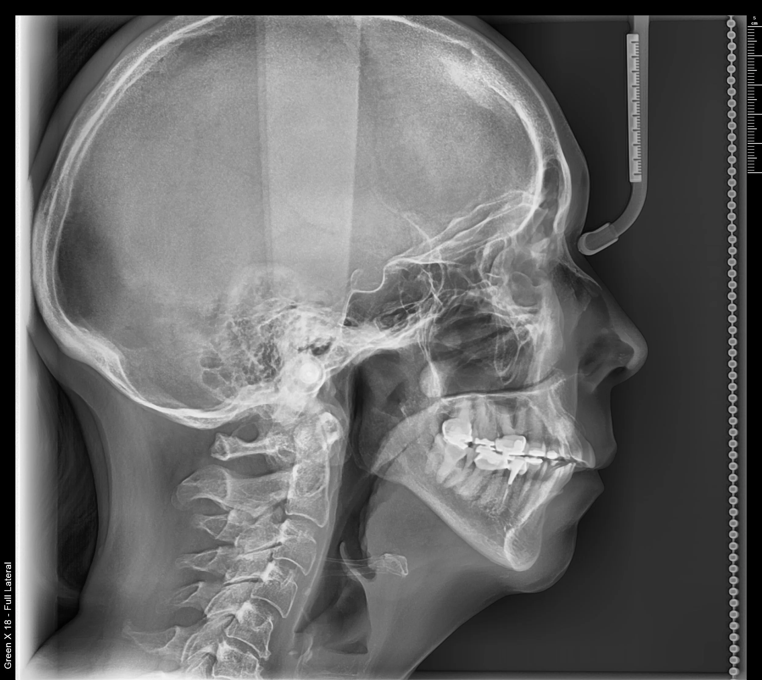 Estudio / Radiografía lateral de cráneo