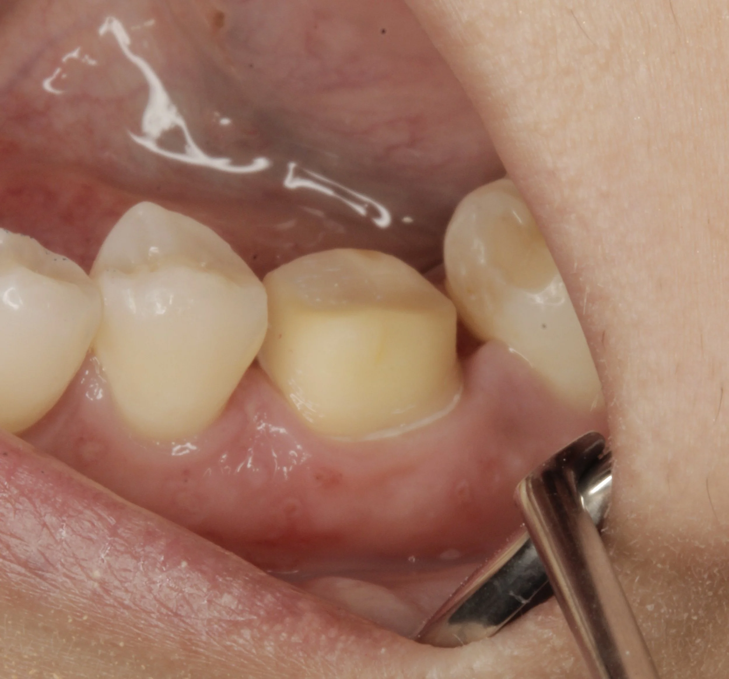 Antes 
Preparación para corona sin metal