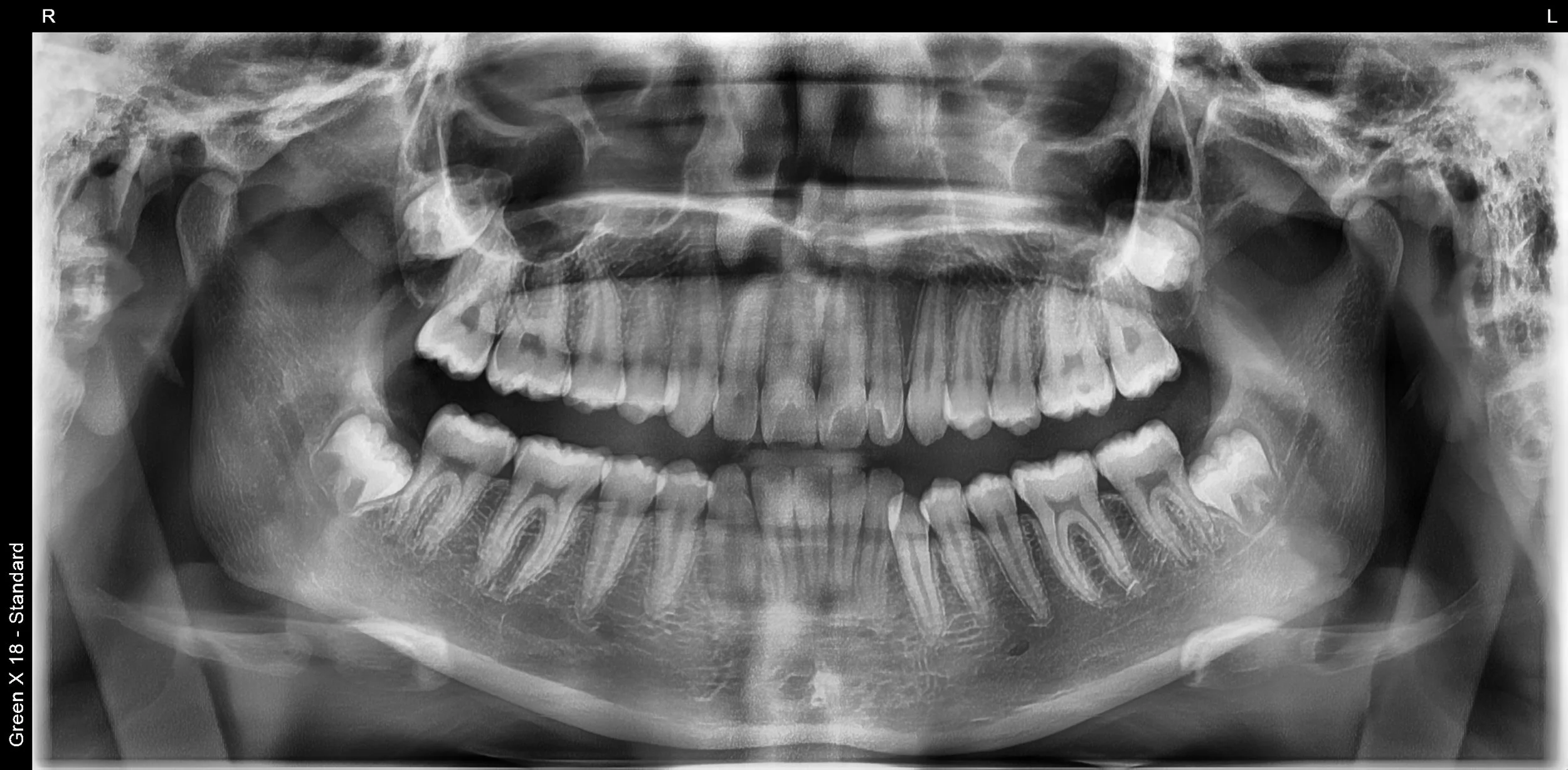Estudio: Rx panoramica