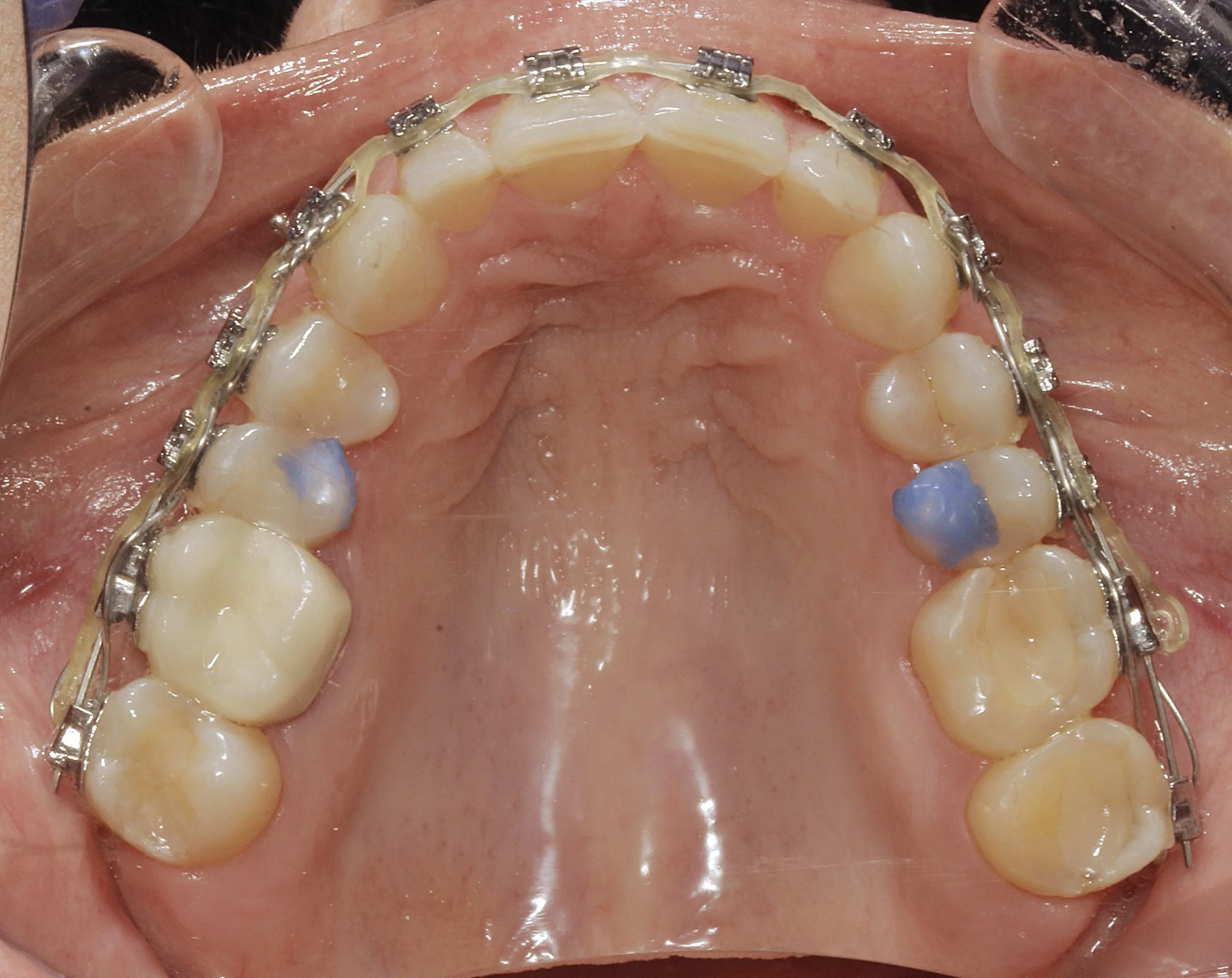 Brackets de autoligado