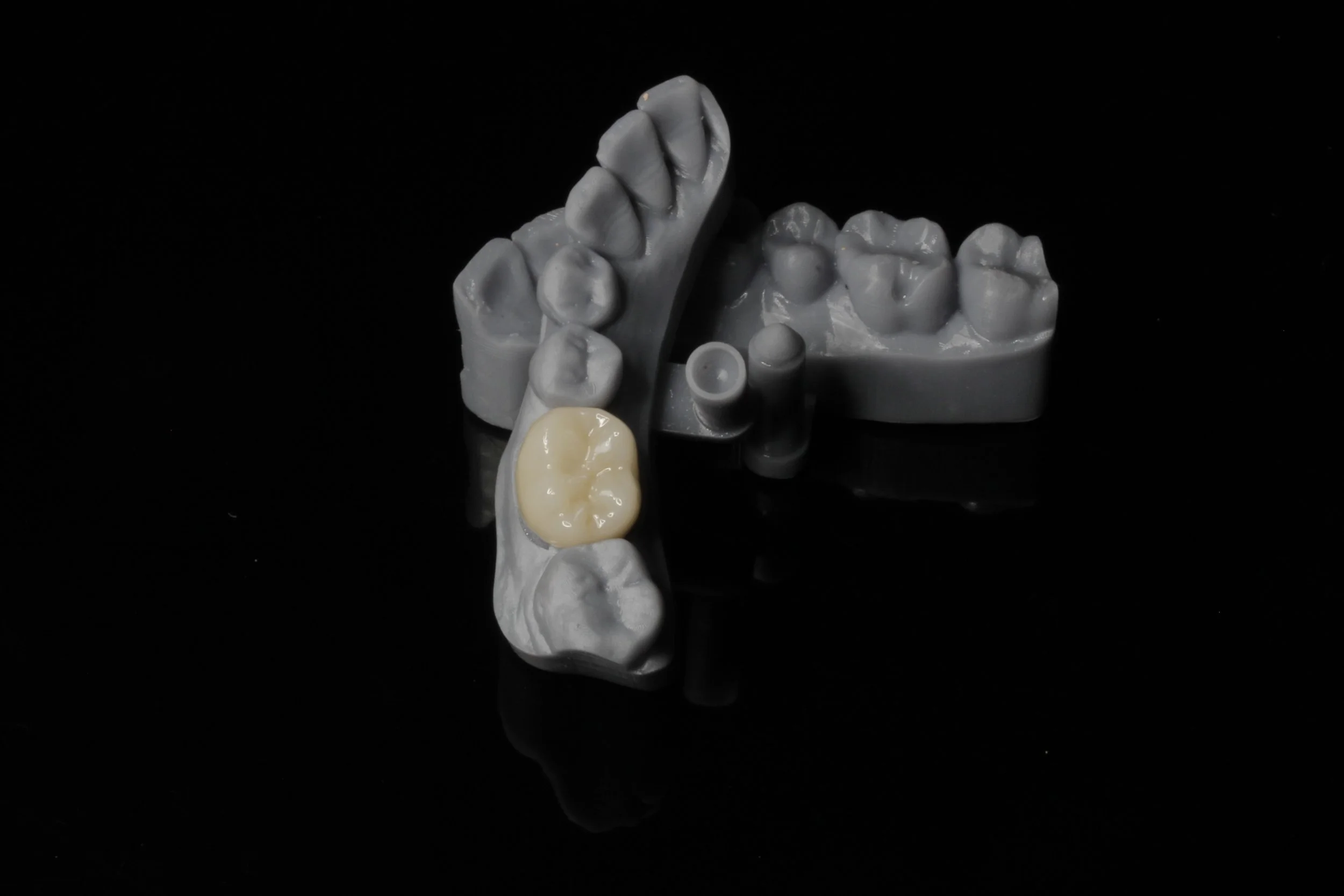 Modelo con corona sin metal.