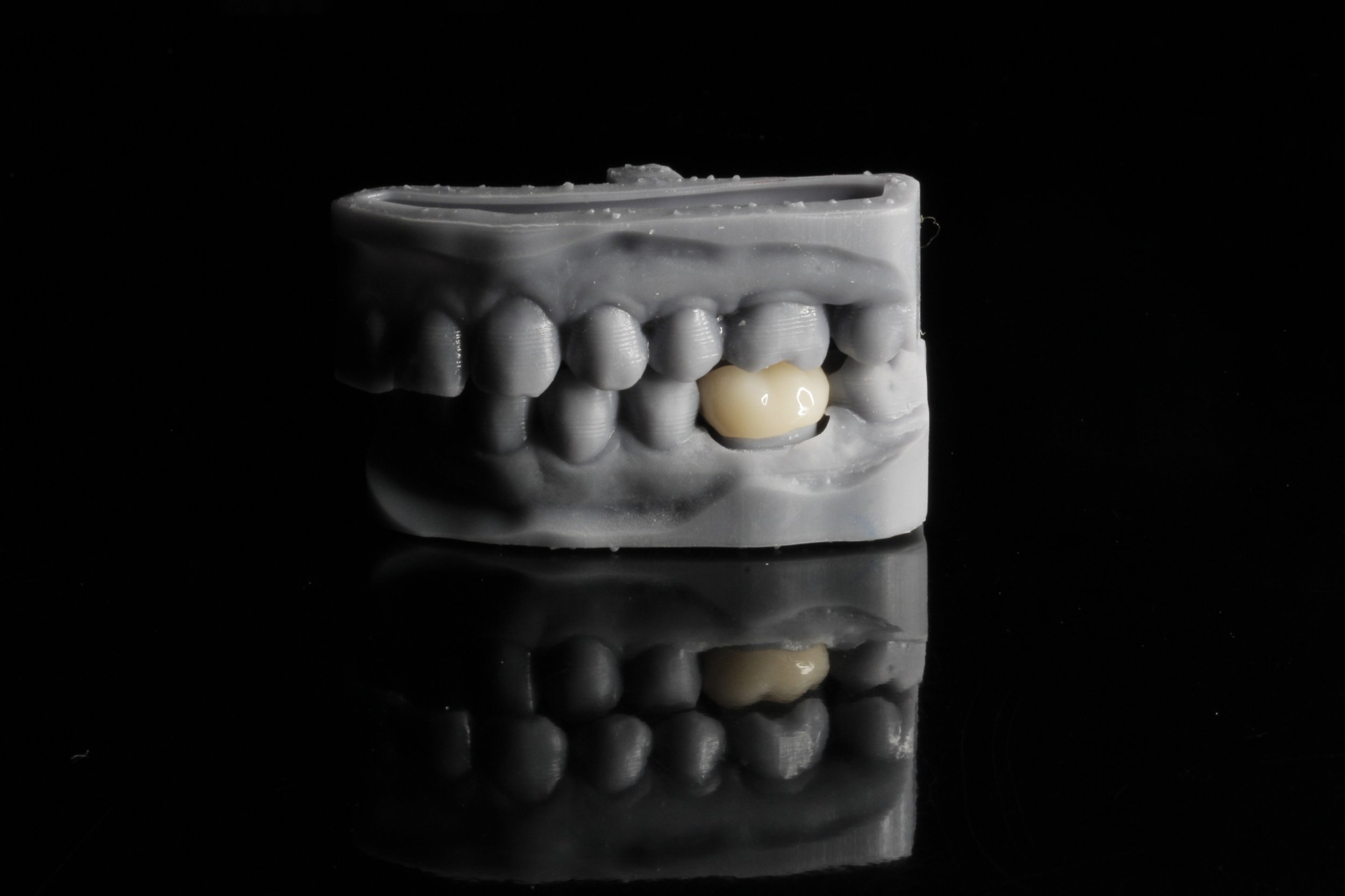 Modelos con corona de zirconia