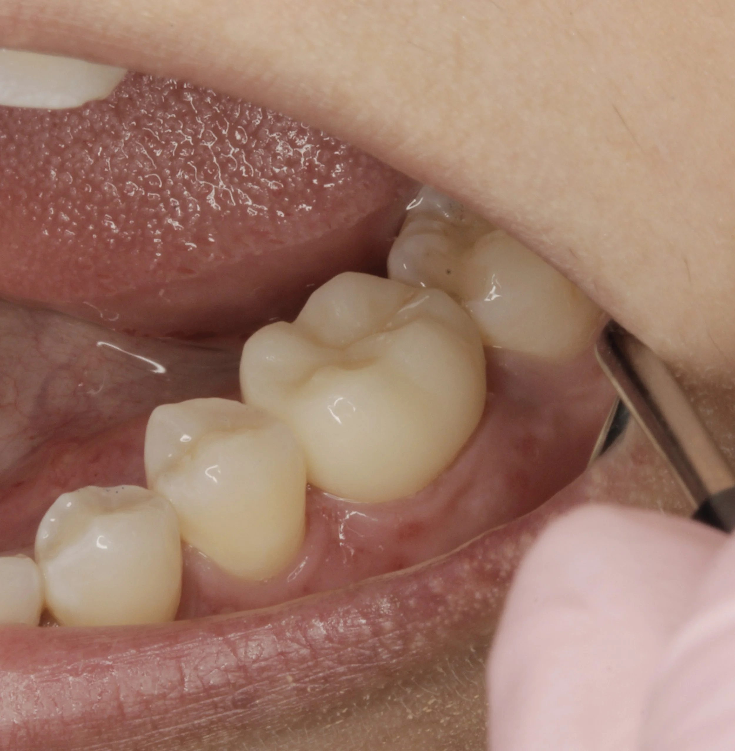 Después
Colocación de corona sin metal