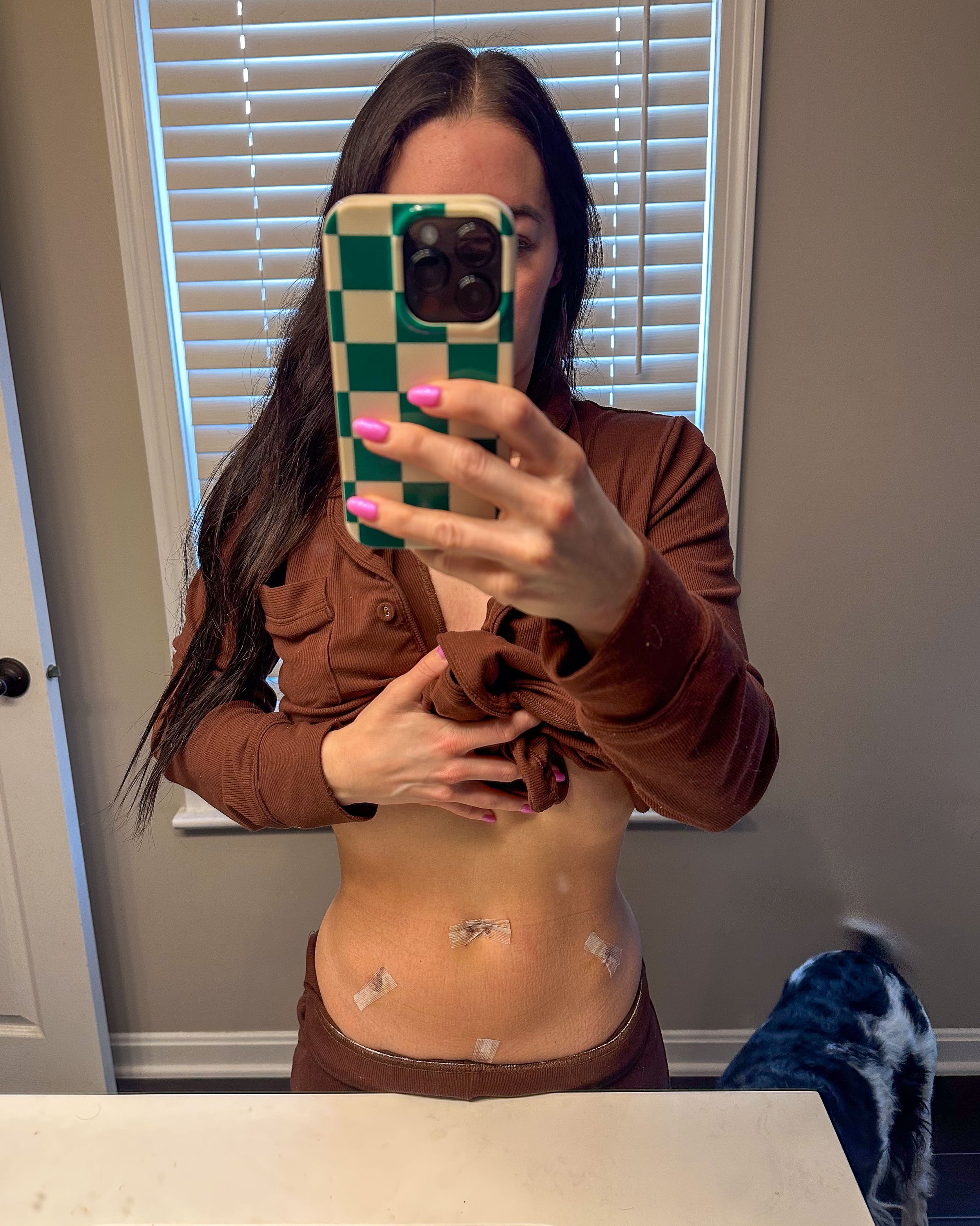 Standing mirror view of small laparoscopic incision sites with surgical strips during early recovery from endometriosis excision surgery