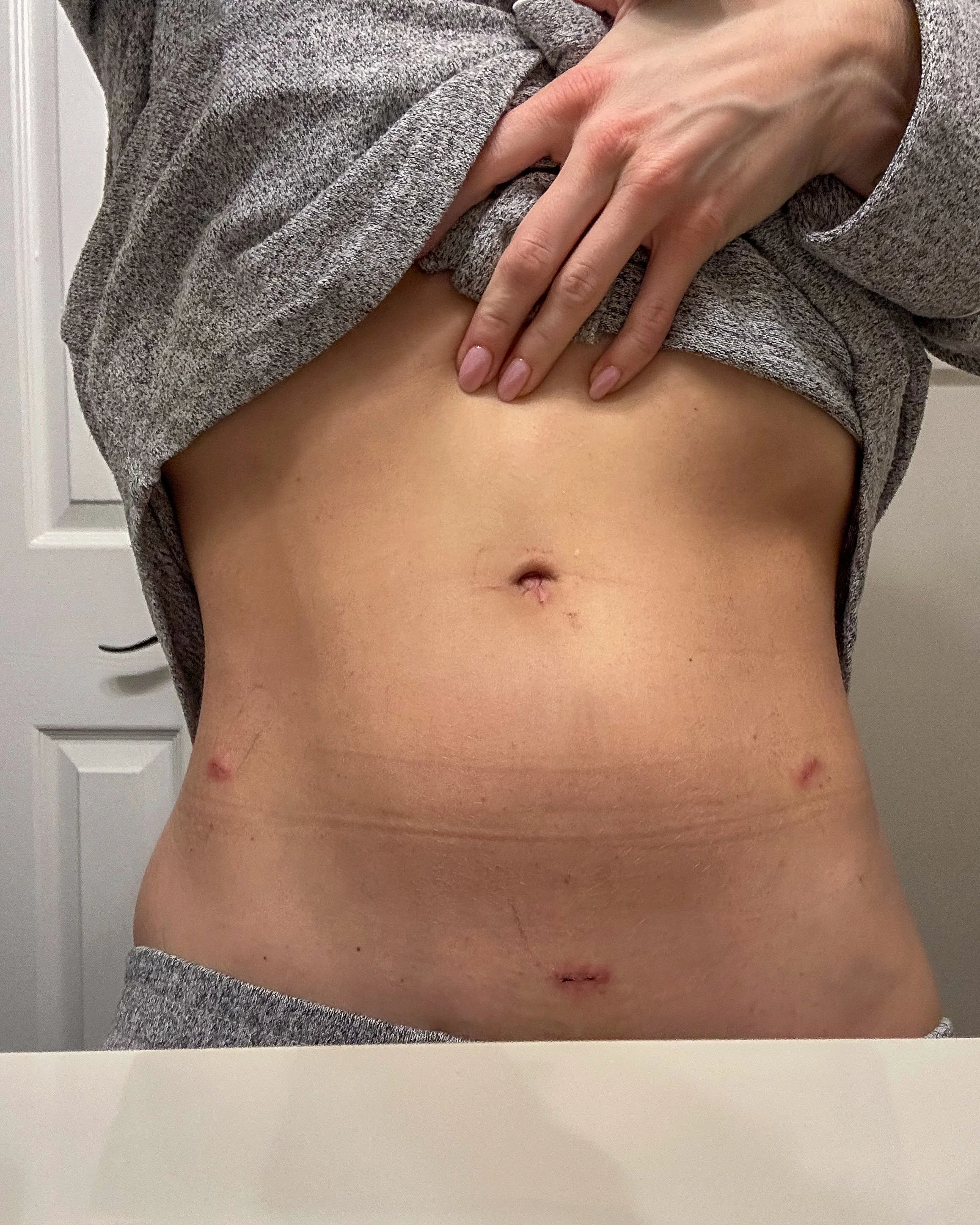 Healed abdomen with faint laparoscopic scars after endometriosis excision surgery, shared by Gabriella Castellani as part of her personal recovery story