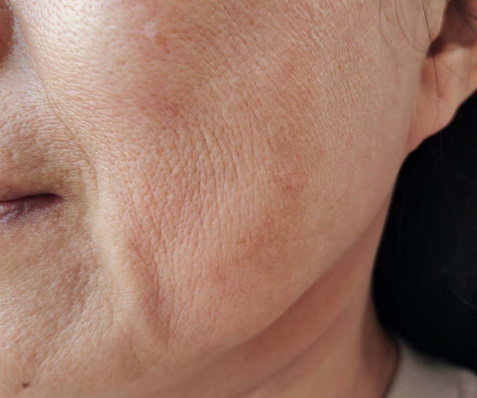 Close-up of a person's face showing textured skin and a portion of the cheek and mouth.