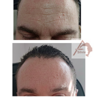 Comparison of a man's forehead before and after hair restoration or treatment, with visible hair growth in the second image.