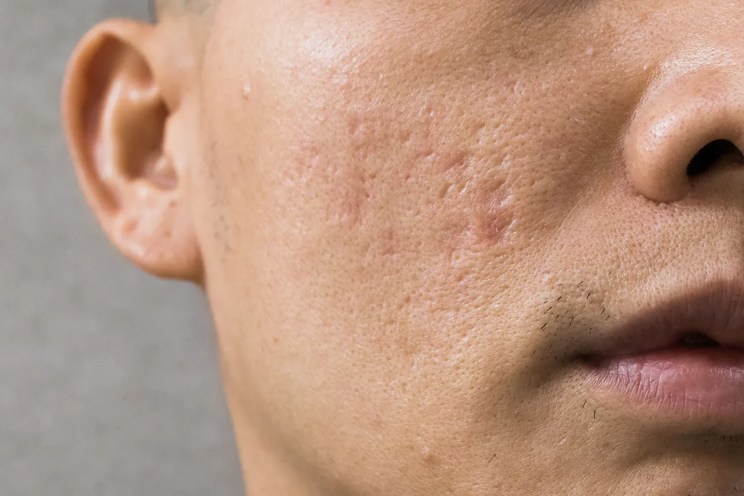Close-up of a person's right cheek showing skin with acne scars and some facial hair.
