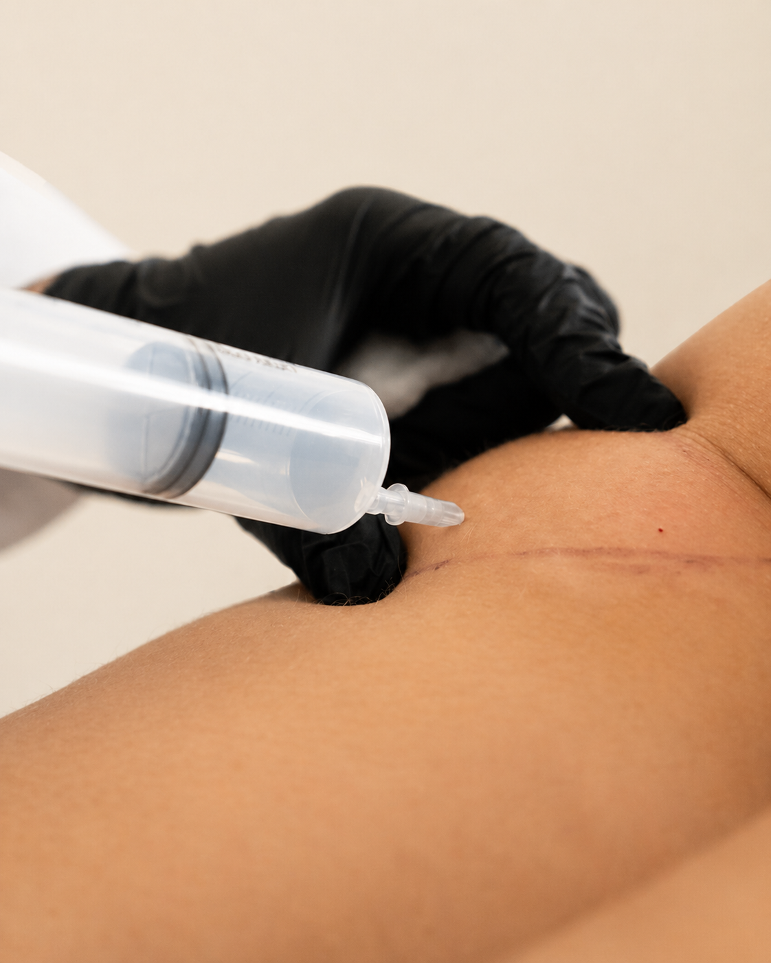 Ozonoterapia Infiltrativa (Dr. Buccomino)