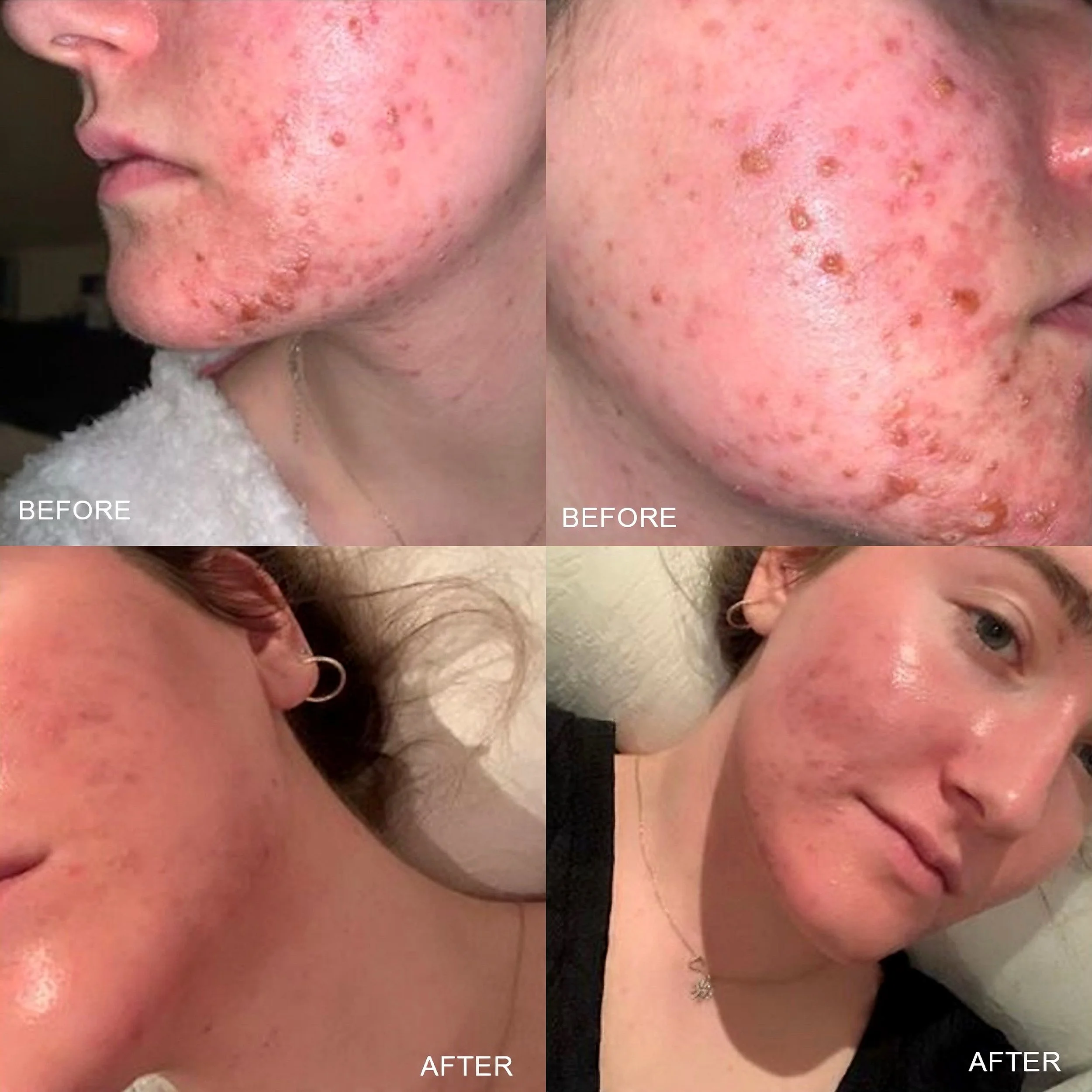 Comparison images showing skin before and after treatment for acne or skin blemishes. The 'before' images depict inflamed, red, and pimple-affected skin on the face, while the 'after' images reveal clearer, smoother skin with a significant reduction in blemishes.