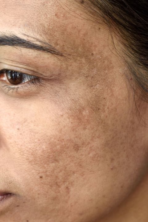 Close-up of a person's cheek with visible dark spots and hyperpigmentation.