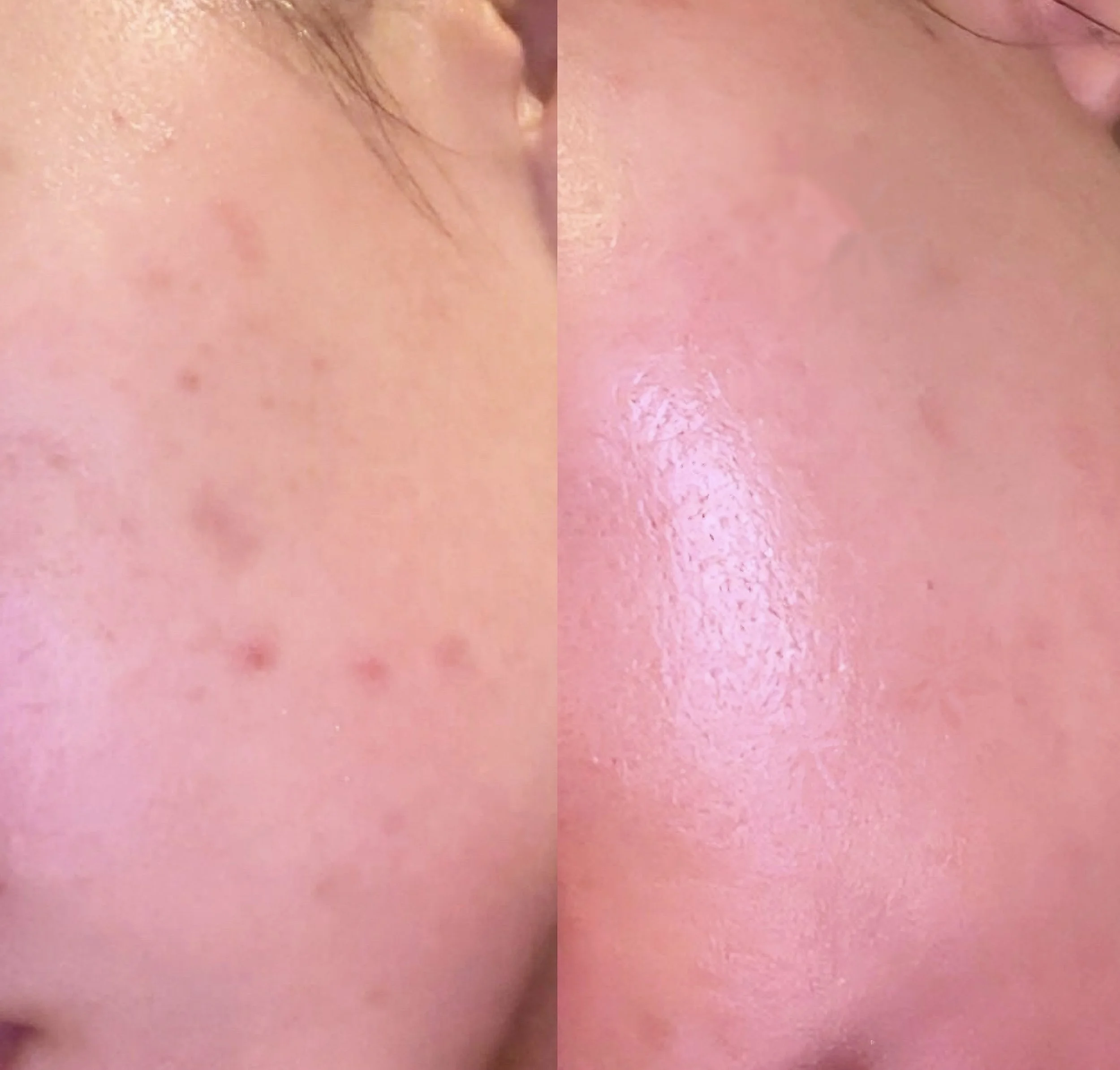 Close-up of a person's skin with visible pores, small moles, and a couple of fine hairs.