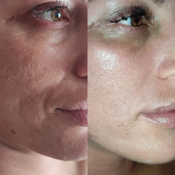 Close-up of a person's face showing a before-and-after comparison of skin condition, with smoother skin on the right side.