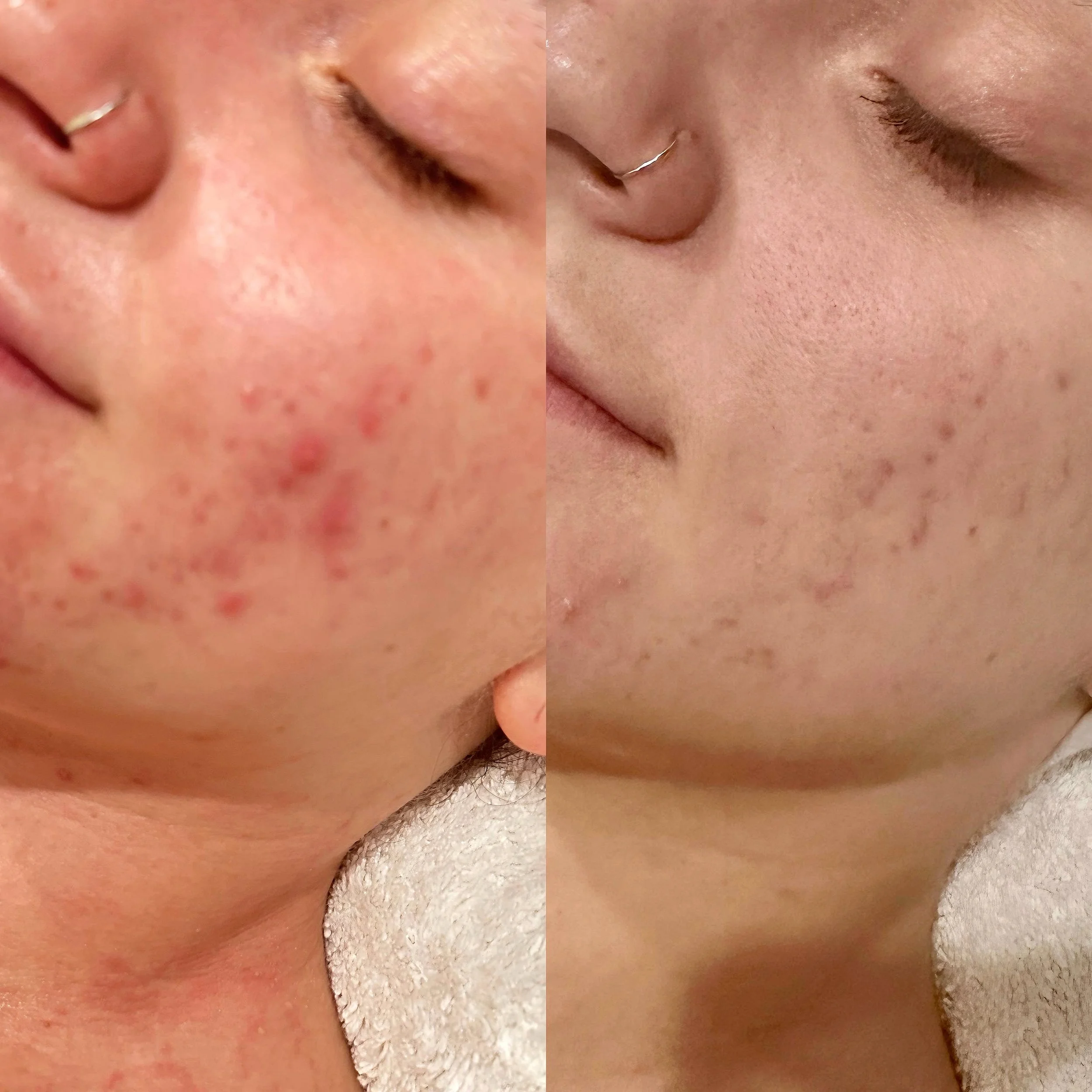 Close-up of a person's face with skin irritation and redness, showing a before and after treatment comparison.