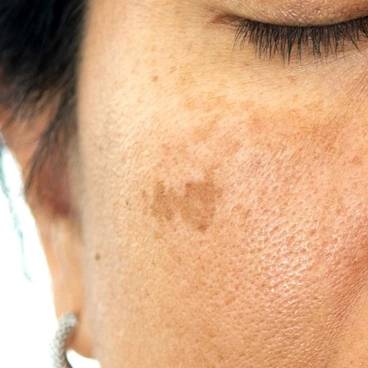 Close-up of a person's face showing a brown birthmark near the eye and cheek with facial skin texture.