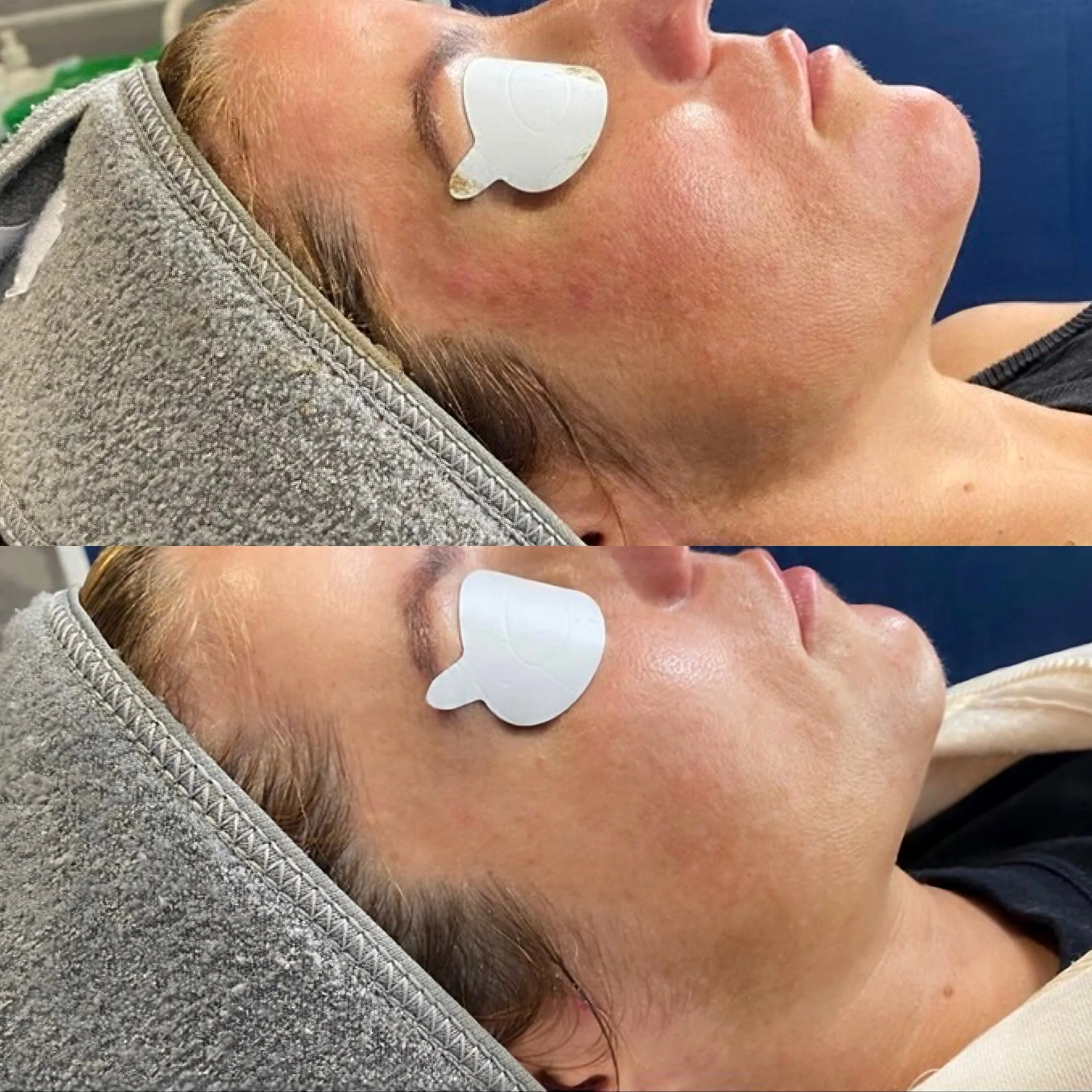Close-up of a woman's face with eye protection patches over her eyes, lying down with her head tilted back. She is wearing a textured gray hoodie, and her skin appears smooth. The background shows a dark blue surface.