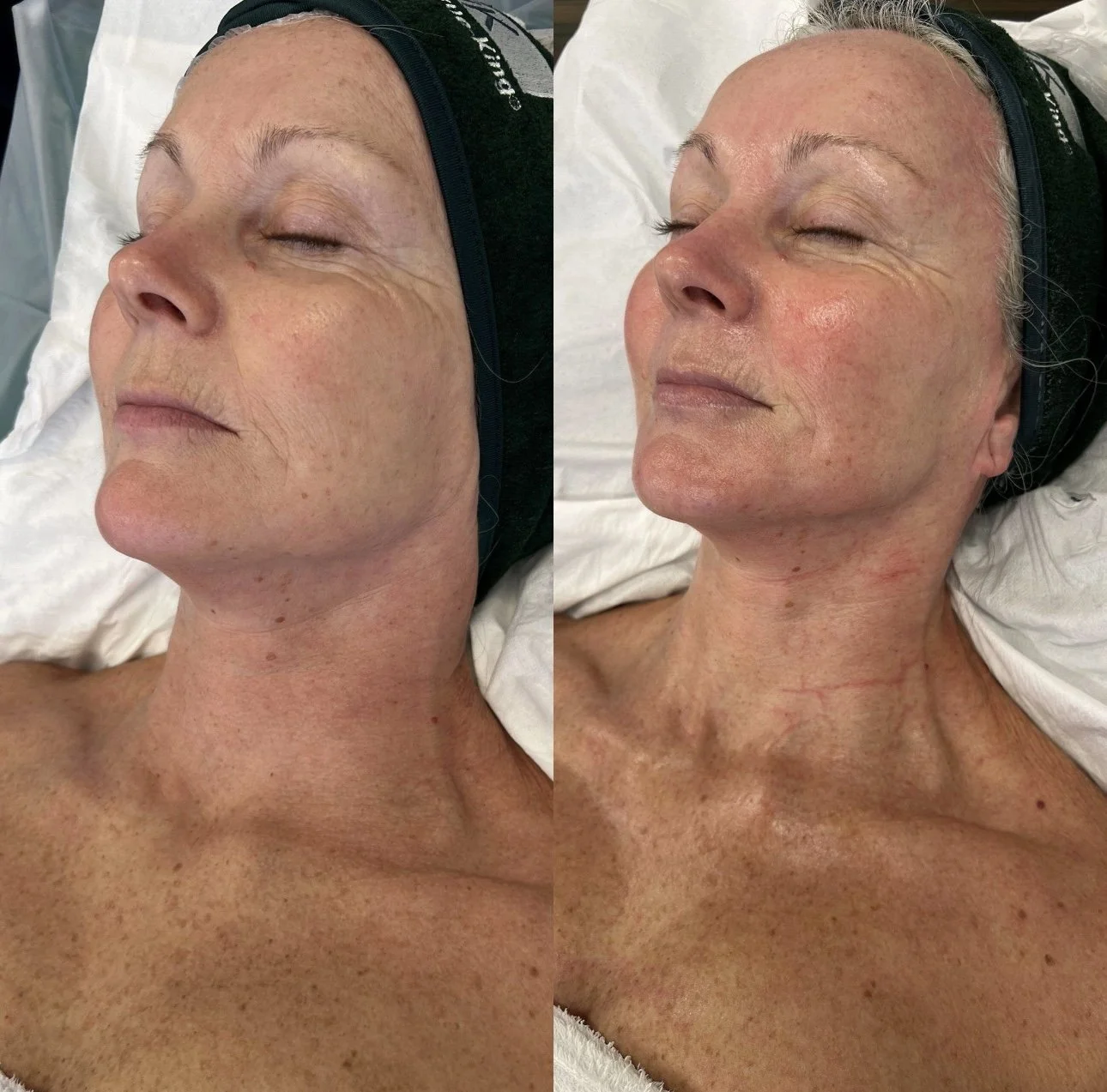 Side-by-side comparison of a woman's face and neck, showing before and after skin treatment results, with the woman lying down.