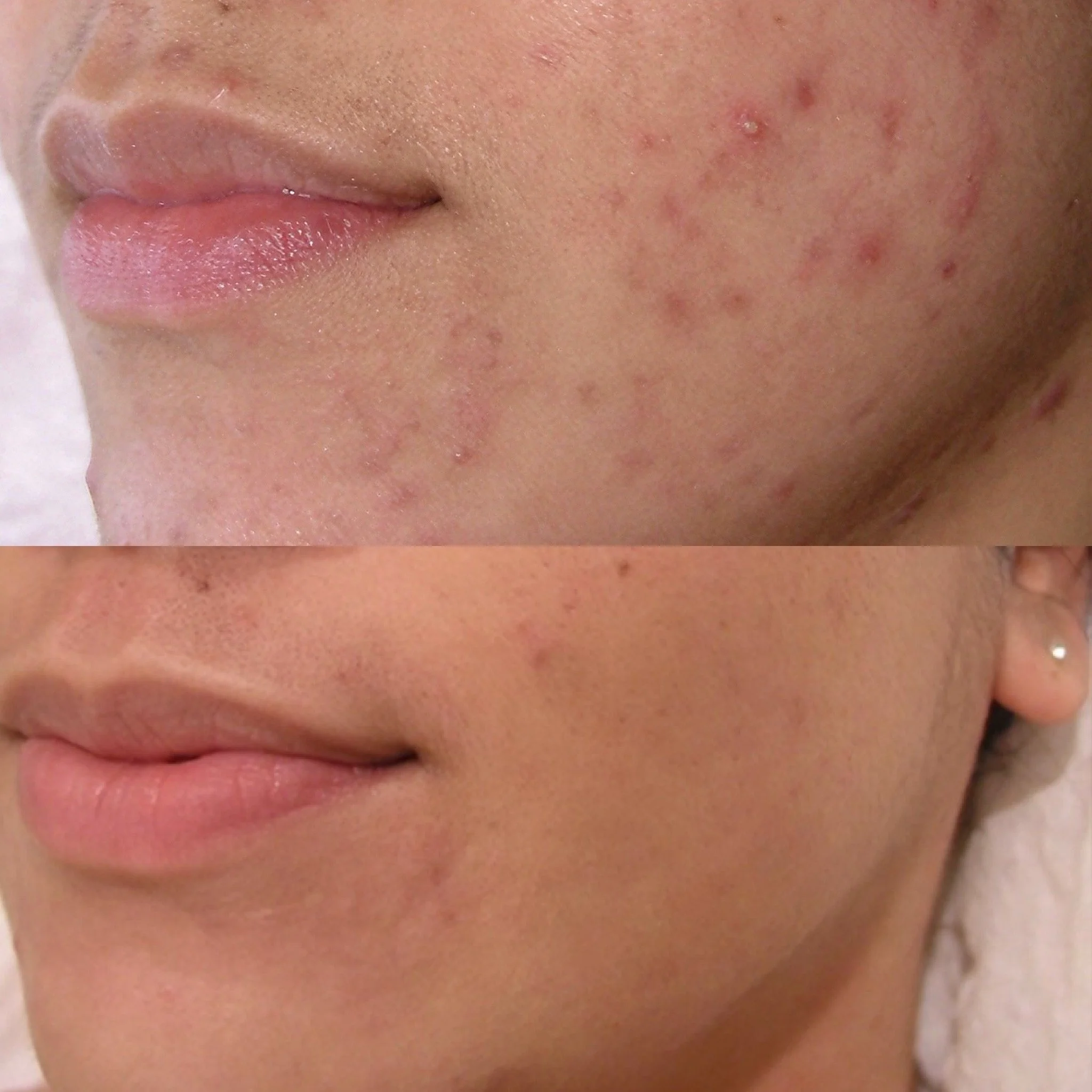 Close-up of a person's face showing skin blemishes, acne, and redness on the cheek and near the lips.