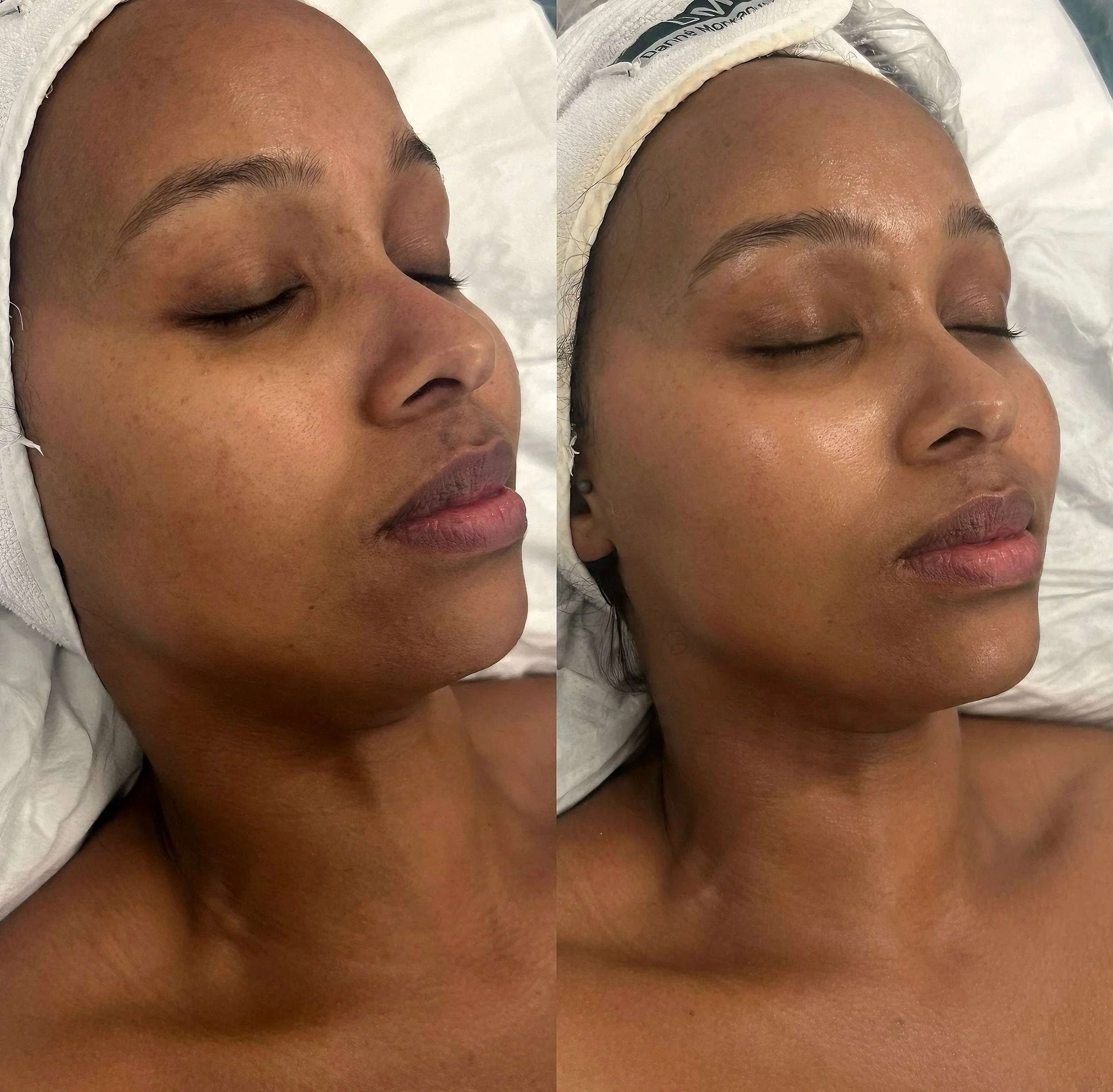 Close-up of a person's face with smooth skin, closed eyes, and eyebrows, lying on a white surface with a medical or spa cap around their head.