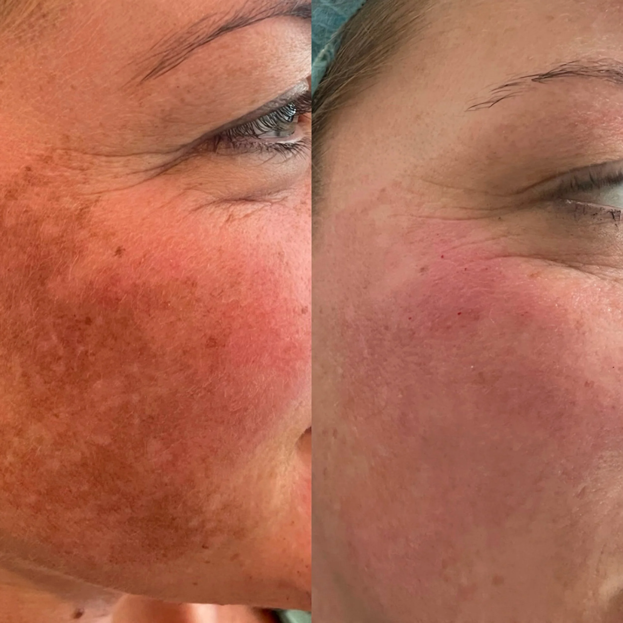 Close-up of a woman's face showing before and after cosmetic skin treatment, focusing on the eye and cheek area.
