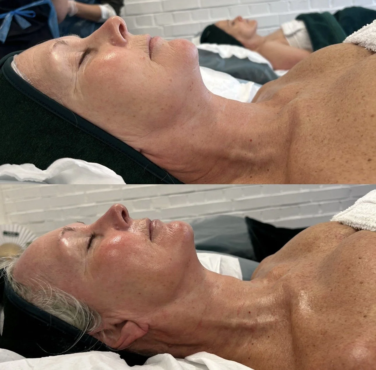 Side view of a mature woman lying down with her eyes closed, before and after a skincare treatment, showing improved skin glow and texture.