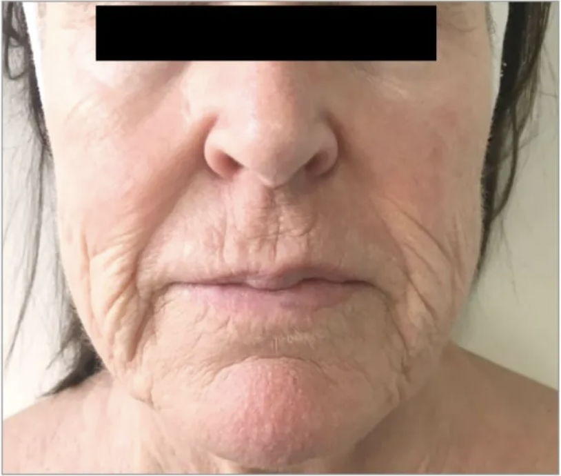 Close-up of an elderly woman's face showing signs of aging, including wrinkles and sagging skin around the mouth and cheeks.