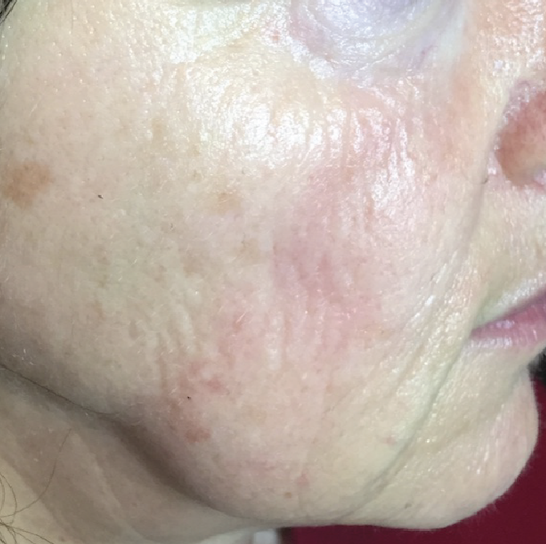 Close-up of a person's cheek showing skin redness and visible fine lines.
