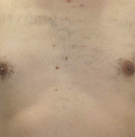 Close-up of a person's chest showing two nipples and some skin imperfections.