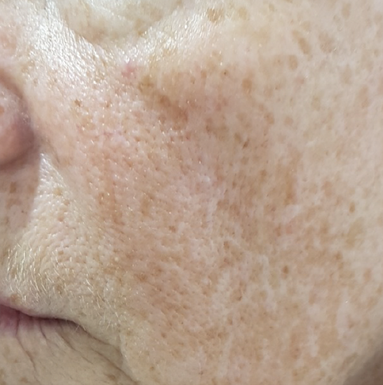 Close-up of a person's cheek showing skin with freckles and visible pores.