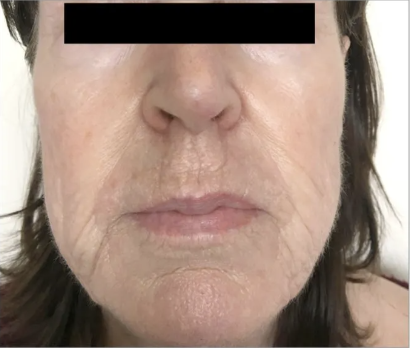 Close-up of an older woman's face showing skin with wrinkles and fine lines.