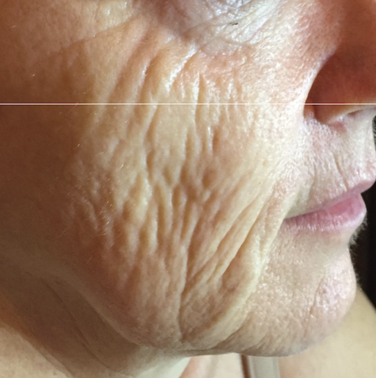 Close-up of an elderly person's cheek and lips showing wrinkled and aged skin.