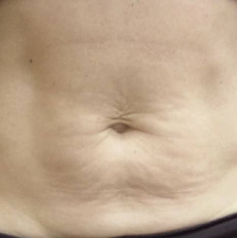 Close-up of a human belly button (navel) and surrounding skin.