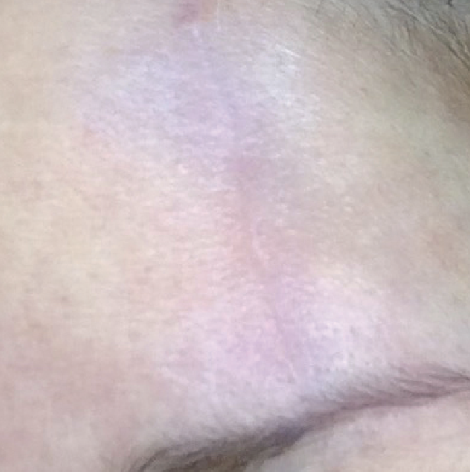 Close-up of a person's skin with visible pores and slight redness.
