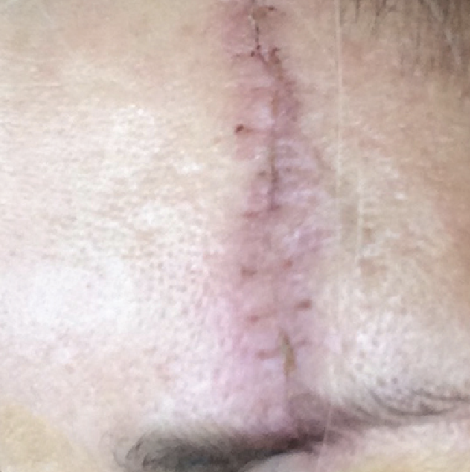Close-up of a person's nose with a vertical surgical scar running down the center.
