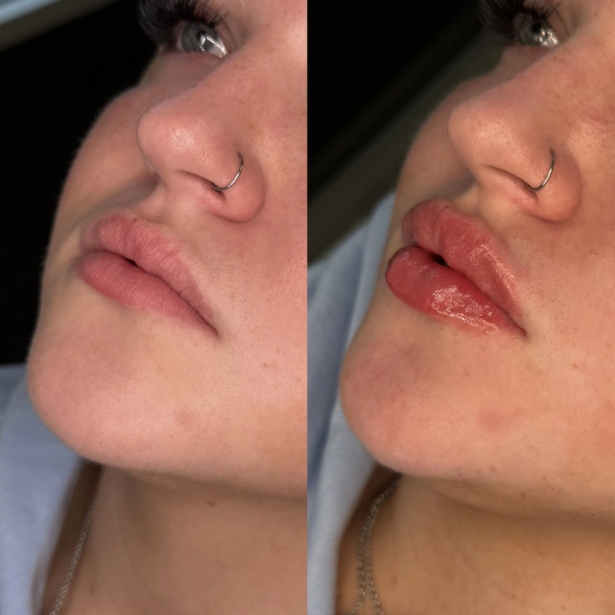 Close-up of a woman's face showing before and after lip enhancement, with the right side featuring fuller, glossy lips.