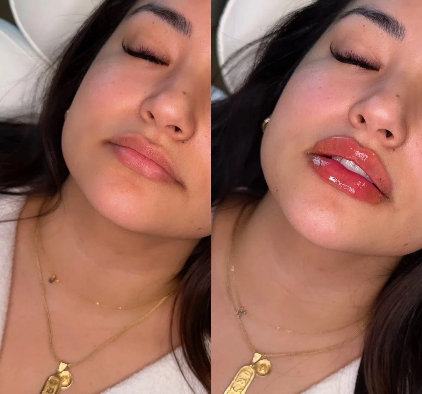 Side-by-side close-up of a woman's face, with eyes closed, showcasing her lip filler results. In one photo, she has natural lips; in the other, she has enhanced lips.