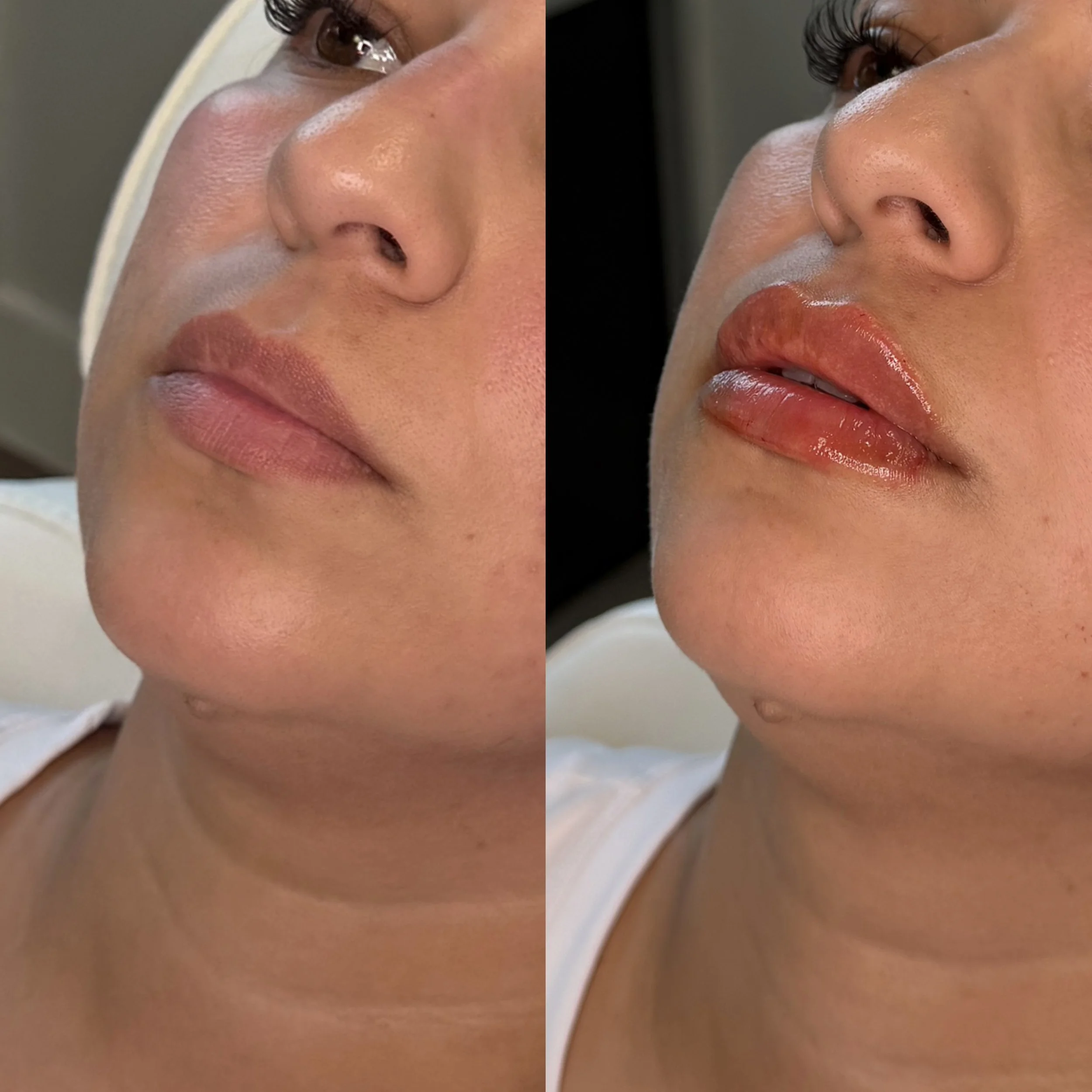 Close-up of a woman's face showing before and after lip enhancement; left side with natural lips, right side with glossy, fuller lips.