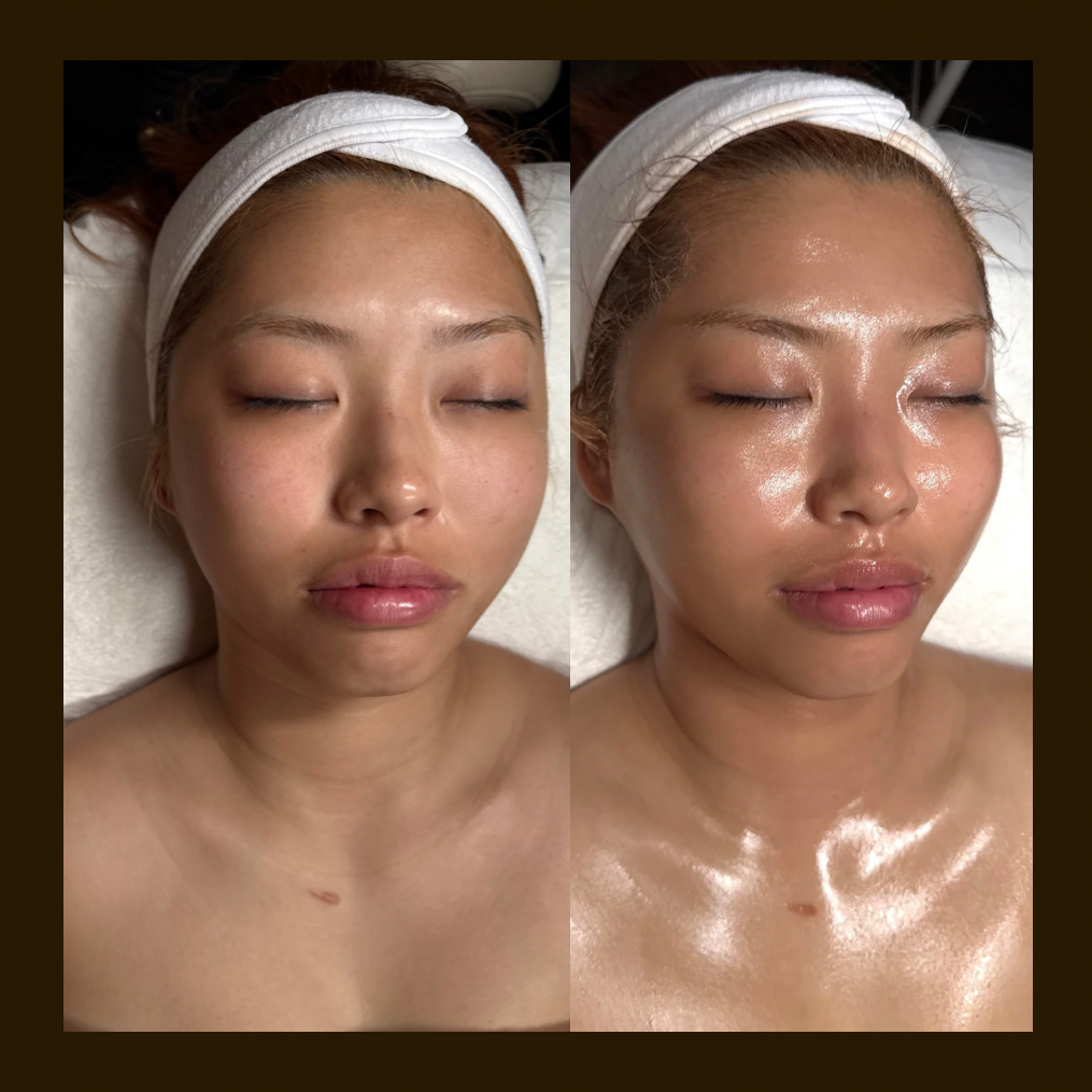 Before and after photo of the everything facial which includes advanced microcurrent, Environ nutrient rich infusion and vagal nerve stimulation curated by Skin Frequencies Studio in Pasadena Ca