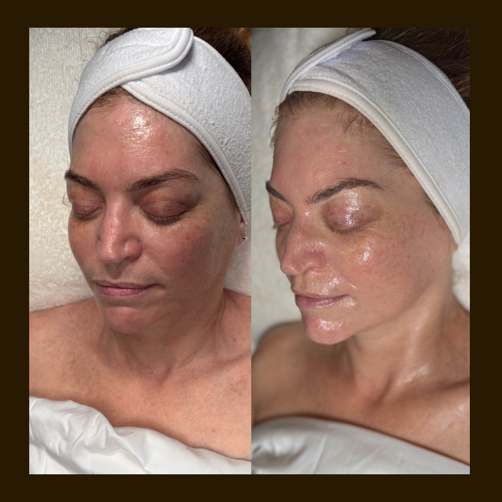 skin frequencies, Pasadena CA, Advance microcurrent results, Showing reduced puffines, improved facial contour and hydrated skin.