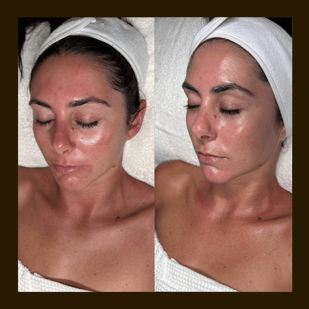 Advance microcurrent Treatment with vagal nerve stimulation selected to support healthy inflammatory biomarkers and local inflammatory regulation  for rosacea prone skin at Skin Frequencies Studio in  Pasadena Ca