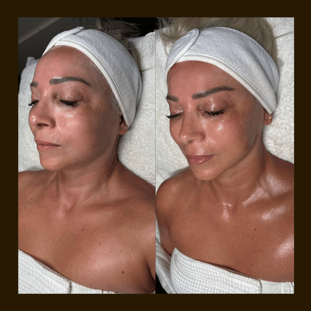  Advance Microcurrent Sculpting  Before and after picture   for wedding prep  Pasadena Ca