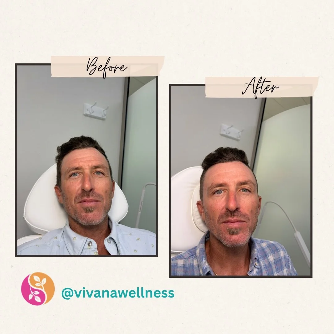 Men need maintenance too. 😏

A little before &amp; after straight from the Man Cave at Vivana &mdash; because looking refreshed doesn&rsquo;t have to mean looking &ldquo;done.&rdquo;

Subtle. Natural. Still you. 👌🏼