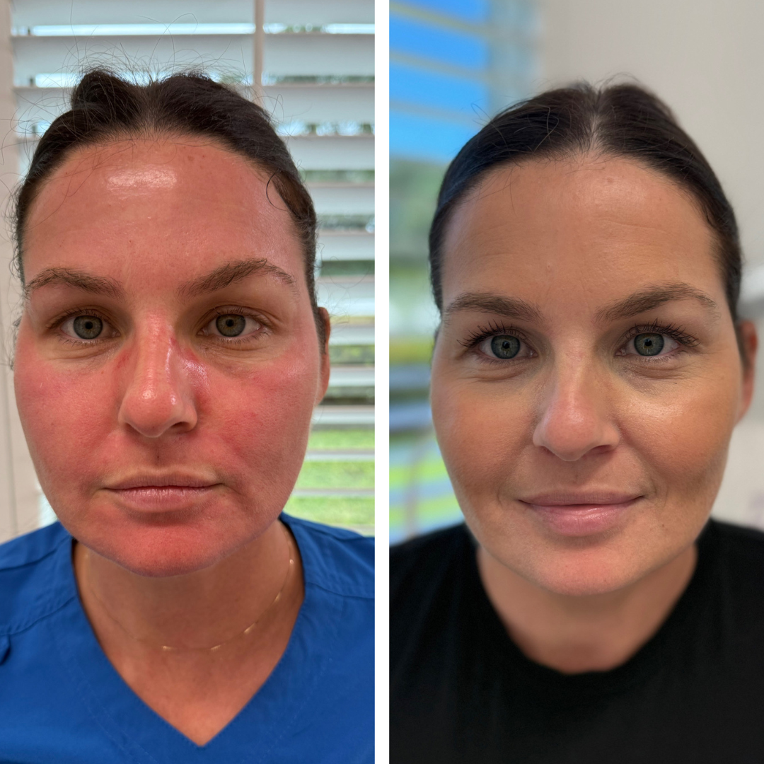 Before and after photos of a woman showing improvement in skin condition. The left image depicts her with redness and irritation, while the right image shows she has clear, smooth skin with a neutral complexion.
