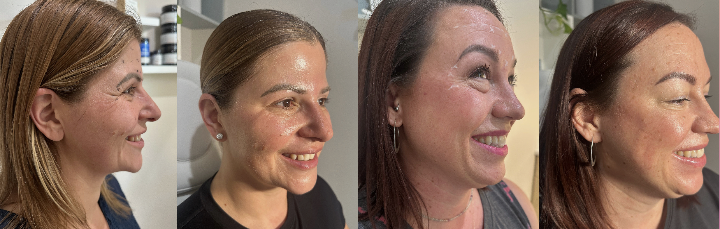 Progression of four women showing skincare improvements over time, with close-up side profiles.
