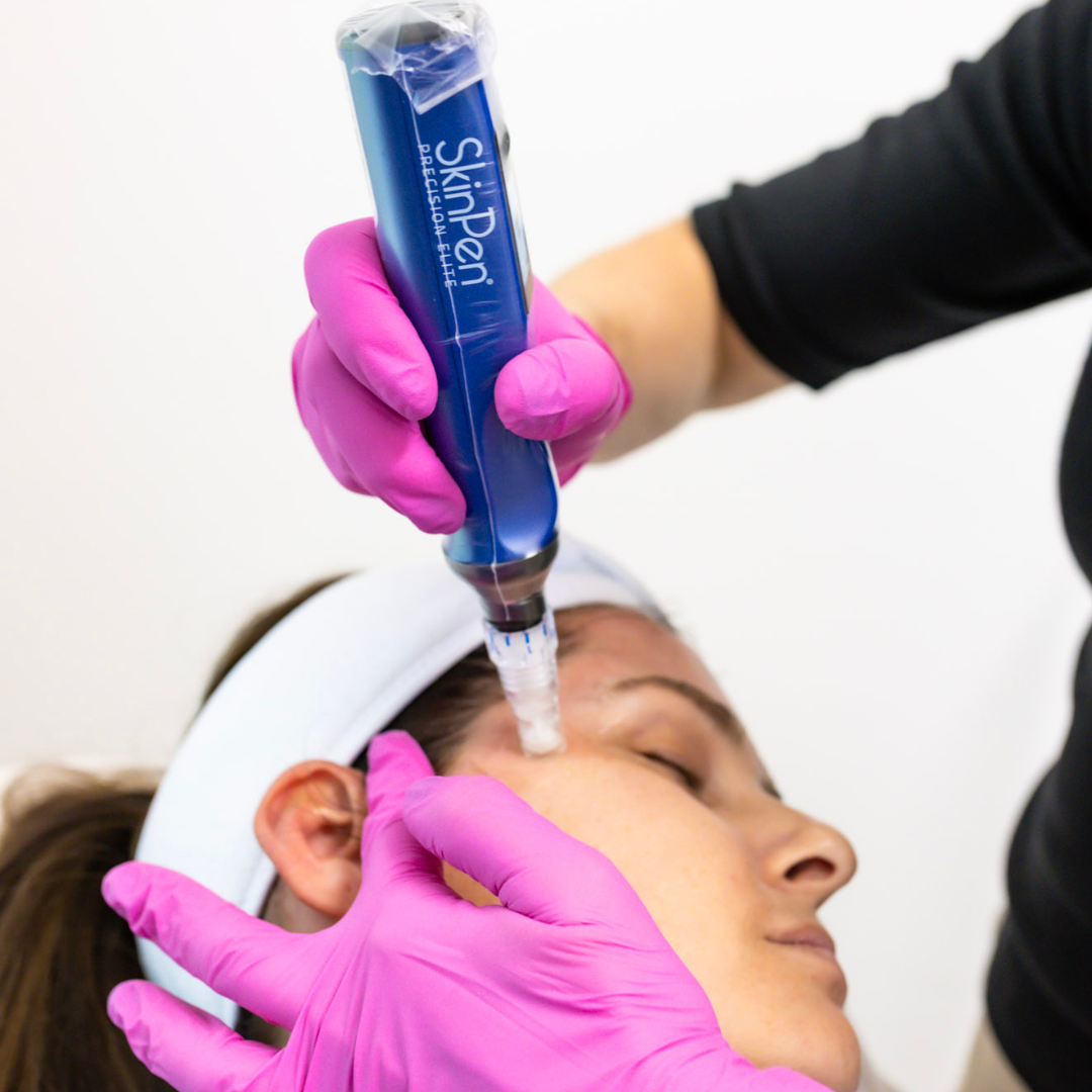 A person lying down with their eyes closed, receiving a facial procedure involving a blue SkinPen device, administered by a practitioner wearing pink gloves.