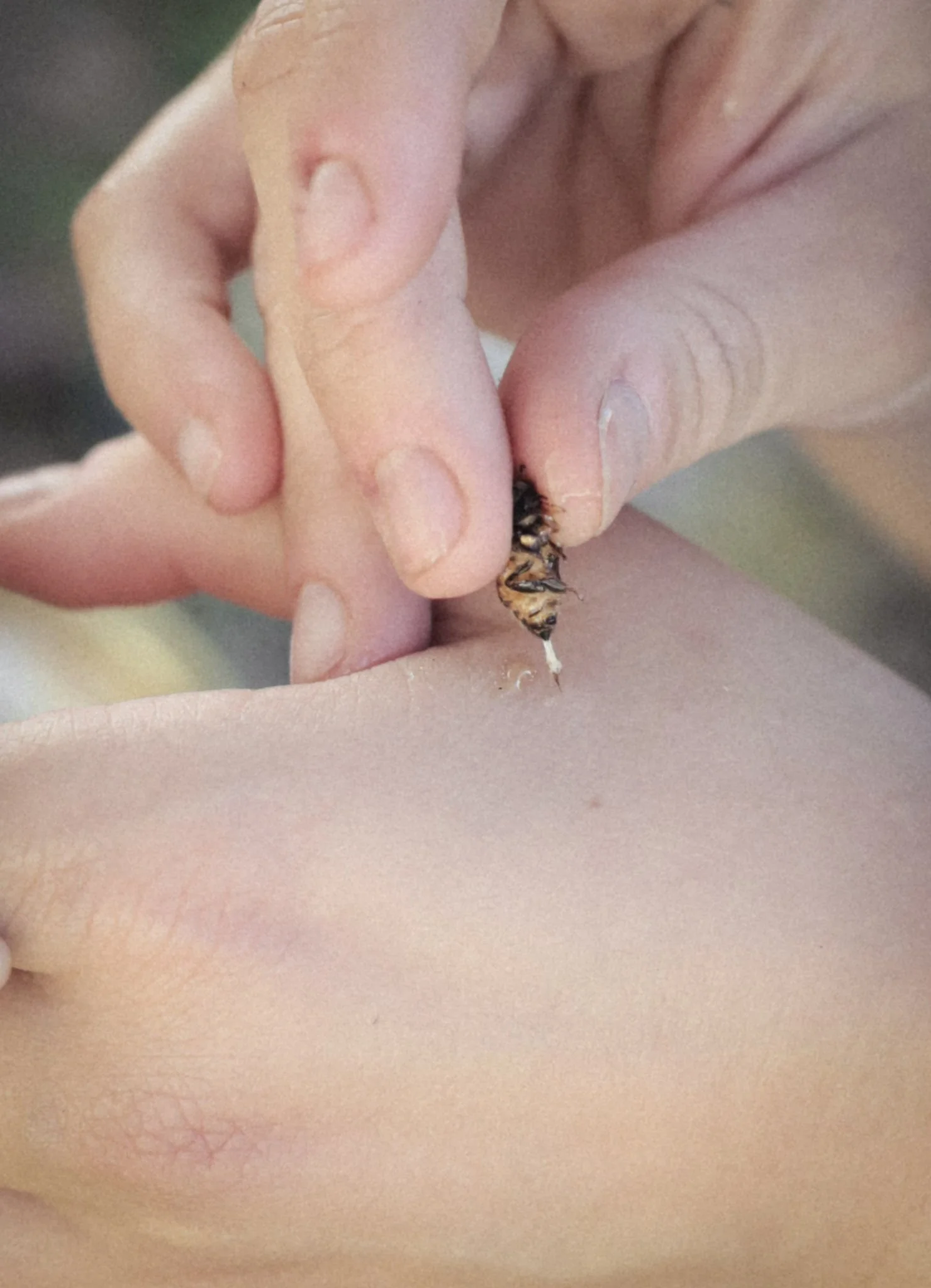 I Thought There Were No Human Studies on Bee Venom Therapy for Lyme. I Was Dead Wrong.